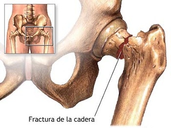 fractura de cadera-fisiosaludmas-fisiosalud